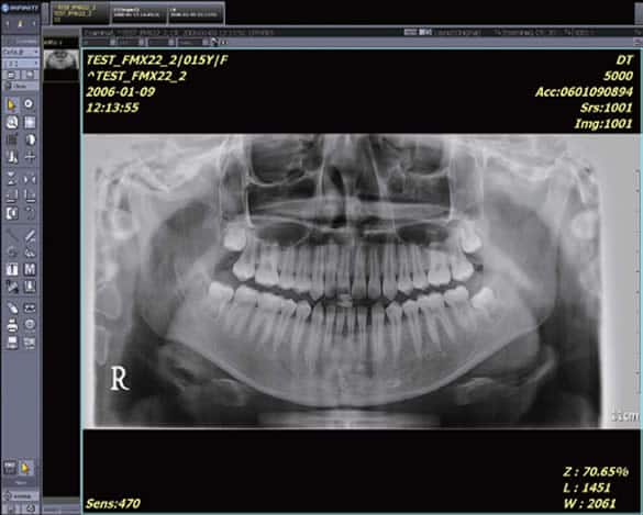 Dental x-ray shown in infinitt PACS App