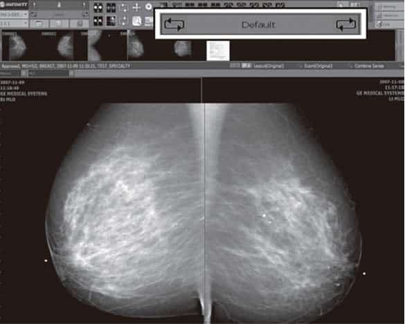 Mammography scan shown in infinitt PACS App