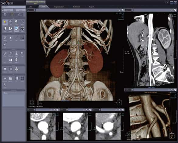 3D view for CT scan shown through infinitt PACS